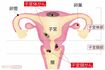子宮頸がんの多くは、子宮頸部の入り口である外子宮口のあたり。子宮体がんは「子宮内膜がん」ともいわれ、子宮内膜に多く発生する