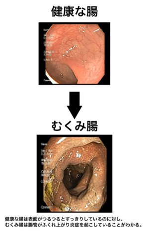健康な腸は表面がつるつるとすっきりしているのに対し、むくみ腸は腸管がふくれ上がり炎症を起こしていることがわかる。