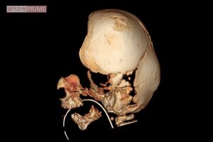 生後4か月のころのCT結果3D再現画像