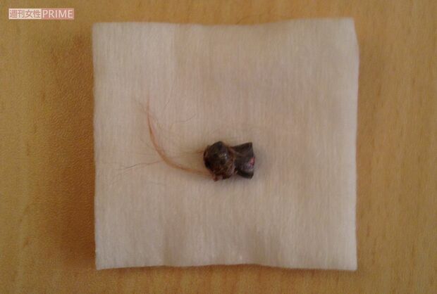 摘出された長さ約8ミリの鉛弾