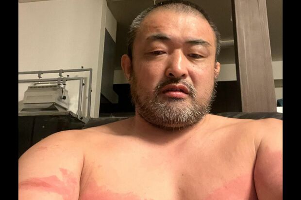 大型魚をプールに移すとき暴れられてミミズ腫れになった江口容疑者（本人のSNSより）