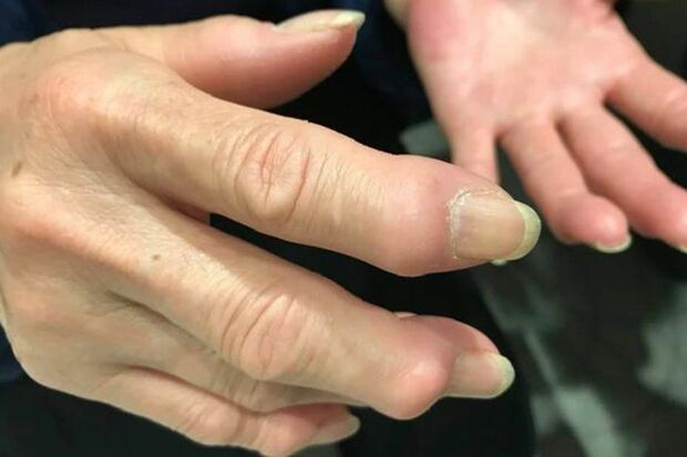 指の変形性関節症は放置すると進行する！