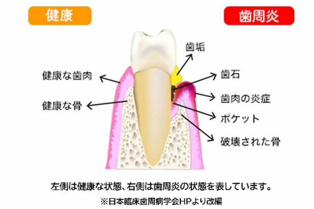 歯周病をわかりやすくイラストで紹介