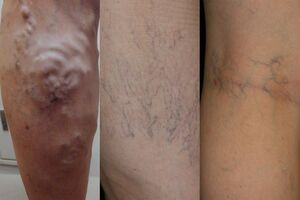 (左から)大伏在静脈瘤、網目状静脈瘤、クモの巣状静脈瘤。血管がボコボコと浮き出る状態のほか、血管の盛り上がりはないものの、血管が青い網目状に浮き出て見えたり、細い血管がクモの巣のように放射状に浮き上がって見えるタイプなどがある。