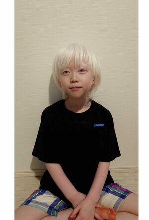 全身の皮膚や髪の毛が生まれつき白い状態のアルビノ。 紫外線から身体を守るメラニン色素をつくれず、 日光でやけどを負う可能性も。約2万人に1人の割合で 生まれる難病