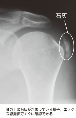 骨の上に石灰がたまっている様子。エックス線撮影ですぐに確認できる