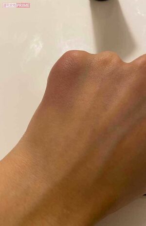 2回目の暴力を受けた際の、絵莉さんの怪我の様子。殴られて転んだとき、左手の小指あたりが青あざに（絵莉さん提供）