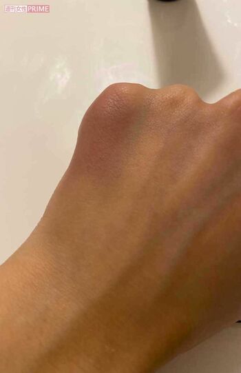 2回目の暴力を受けた際の、絵莉さんの怪我の様子。殴られて転んだとき、左手の小指あたりが青あざに(絵莉さん提供)