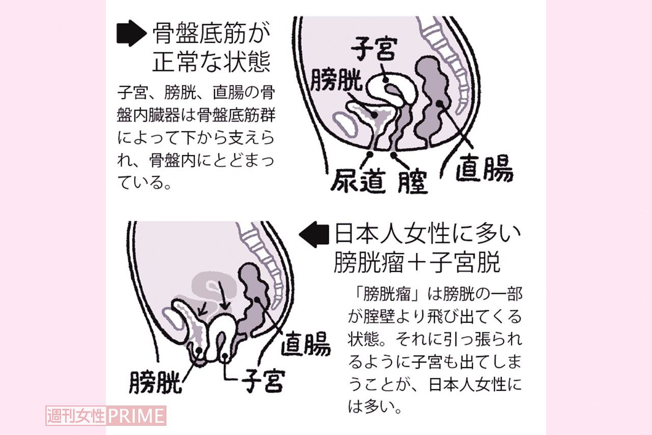 膣 から 便