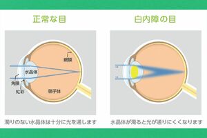 白内障の症状（白内障LAB公式サイトより）