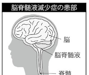 自ら死を選ぶ人もいる「脳脊髄液減少症」の恐怖