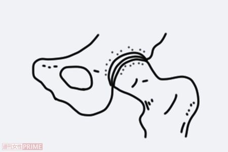 2.初期股関節症（イラスト／赤松かおり）