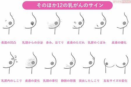 そのほか12の乳がんのサイン　イラスト／スヤマミヅホ