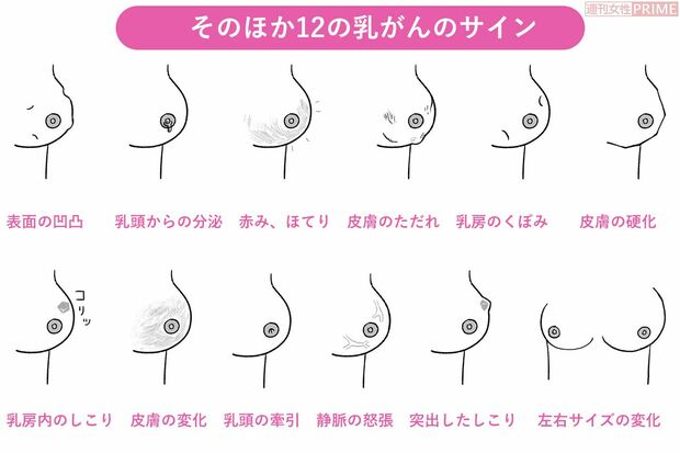 そのほか12の乳がんのサイン　イラスト／スヤマミヅホ