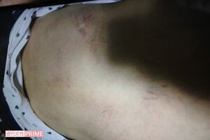 今年1月29日に家族のケータイで撮影された暴行後の少女の背中。赤紫色のあざと擦り傷だらけで痛々しい。これはいじめの域を超えた暴行事件だ