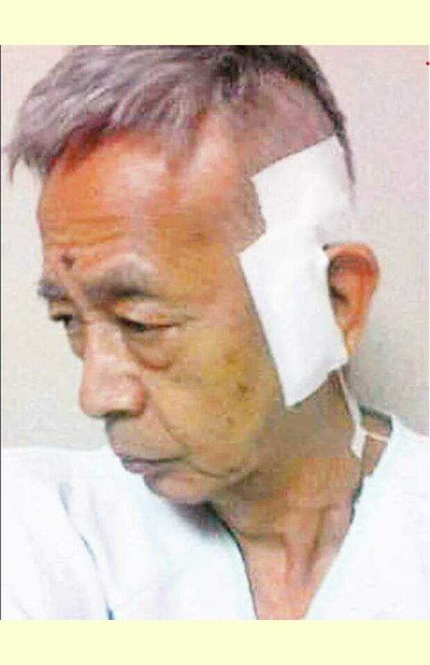 治療中の村野さん。耳の上の動脈に穴を開けて、がんがあるところにカテーテルを入れて抗がん剤を流し込む