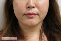 デカ顔に悩み、高須クリニックで小顔化メニューを試した結果「痛みなくシャープに!」