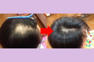 横田さんのマッサージで髪が増えた！ビフォーアフター