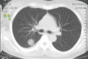 松本みゆきさんが見ても、すぐに「肺がんだ」とわかったというCT画像。白い影がはっきりと写り込む