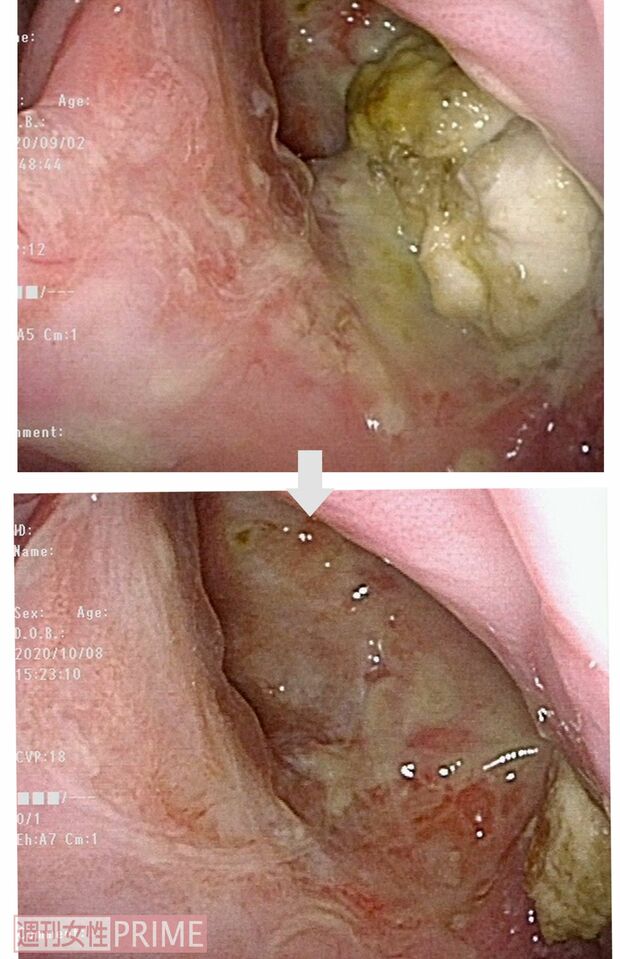 【症例1：70代男性 左上顎洞がん】内視鏡で見たBNCT治療前後の様子。溶けるようにがんが消失