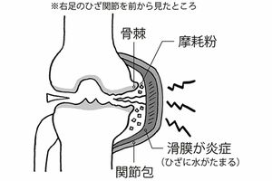 ひざ痛が起きるメカニズム