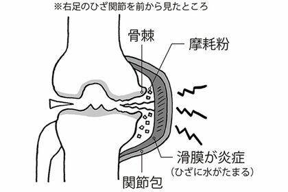 ひざの痛みは1日80秒“お皿”を回すだけで軽減、“全国の6人の治療家”の