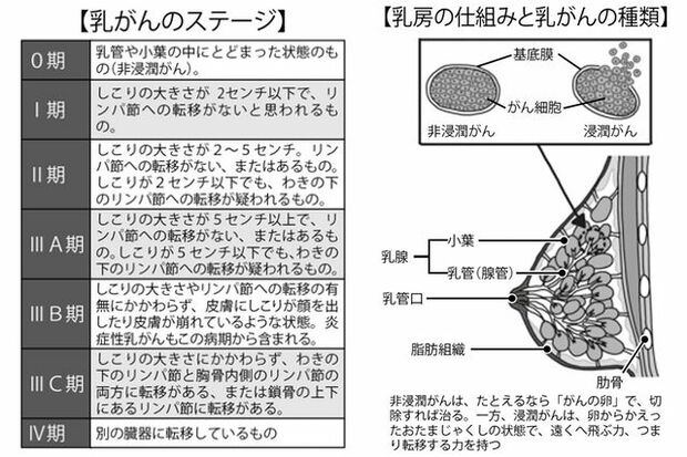 乳がんの最新治療　がんのサブタイプが治療法選択の有力情報