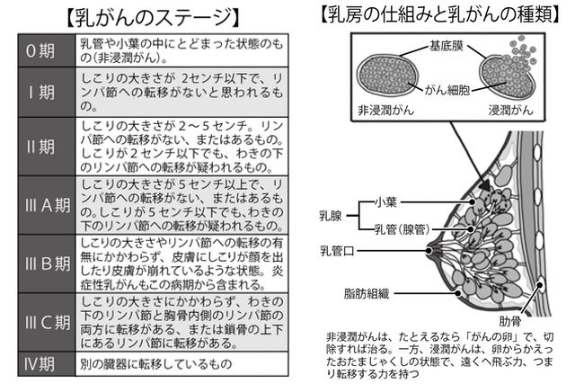 乳癌手術略語 – 乳癌手術 Bp Sn – 乳房再建/シリコンインプラント・LD・DIEP/形成外科 – UAIQMW