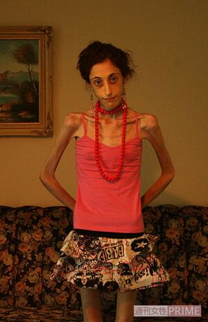 写真の少女は18歳。拒食症に苦しみ、体重は30キロに満たないという。生命維持にも支障をきたす状態だ