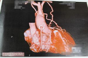 急性心筋梗塞で緊急搬送され、バイパス手術を受けた山上さんの術後の心臓写真。周囲の管が大がかりな手術だったことを物語っている