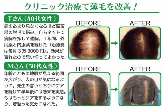 頭皮の夏バテ が秋に抜け毛を引き起こす 最新予防対策 治療法で薄毛に勝つ 週刊女性prime