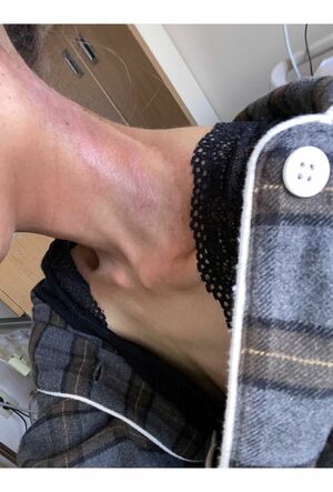 初めての放射線治療で、ヤケドを負いケロイドになった首