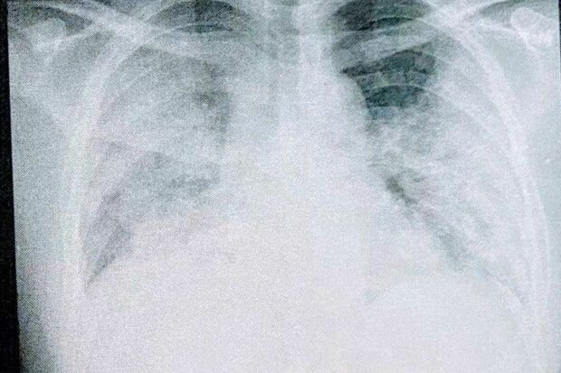 「もう助からない」専門家ですらそのように見えたほど真っ白になった肺。これが37歳のコロナ患者が味わった現実だ（写真：取材者提供／東洋経済オンライン）