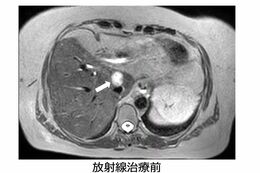 【症例】胆管がん59歳女性（画像提供:GenesisCare）