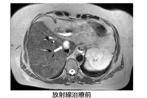 【症例】胆管がん59歳女性（画像提供:GenesisCare）