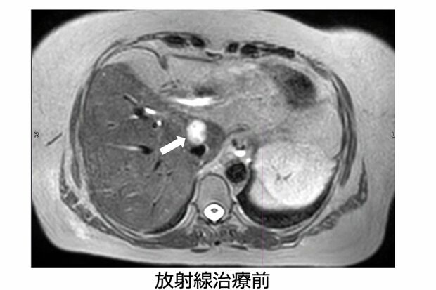 【症例】胆管がん59歳女性（画像提供:GenesisCare）