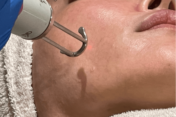 『トーニング』。施術時間も短く、ダウンタイムの心配も少ない、定番で受ける人も多いというトーニングは、シミやくすみの改善効果が！