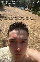 インスタグラムで痛々しく怪我をした顔面を見せるマリウス葉