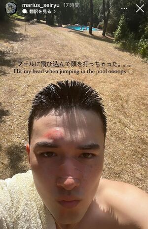 インスタグラムで痛々しく怪我をした顔面を見せるマリウス葉