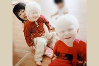 髪や肌が生まれつき白い病気 “アルビノ”女性が語る「いずれ失明する運命」それでも悲壮感がないワケ