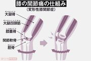 梅雨どきに気になる関節痛が男性よりも女性が2.3倍も多いのは更年期が関係、予防のキーは体重管理と筋力「危険信号の目安は、肥満度を表すBMIが25以上」