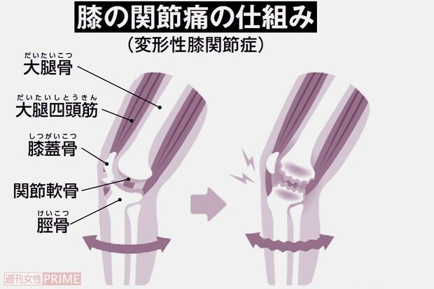 膝の関節痛の仕組み