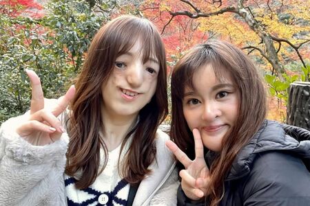 トリーチャーコリンズ症候群の山川記代香さん（左）と口唇口蓋裂の小林えみかさん