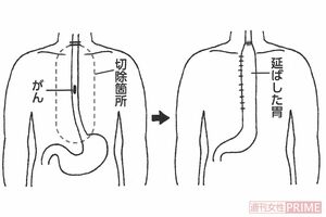 食道がんの手術、こんなに大変!(1)胸部食道がんの場合、のど、胸、お腹と3つの領域にわたって切り開き、食道を切除する(2)胃を管状にして残った食道とつなげる。管は大腸や小腸で代用も(イラスト/小島サエキチ)