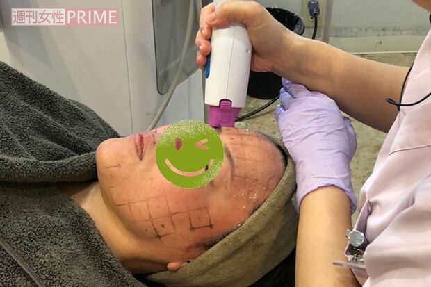 くまなく照射するため、顔にマス目ををつける（施術後にきれいに消してくれるのでご安心を）。さらに、肌の奥の層まで電気の通りをよくするための専用ジェルを塗布