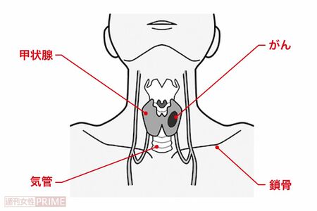甲状腺がんの位置　イラスト／青井亜衣
