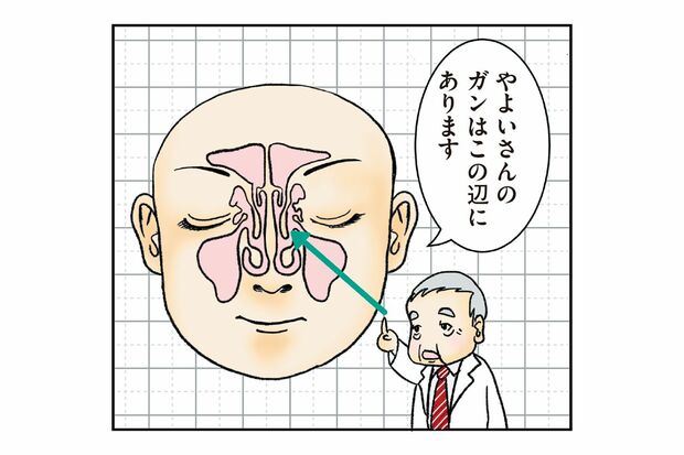 鼻の内部の「鼻腔」にできるのが「鼻腔がん」。鼻腔の周辺にある空洞の「副鼻腔」にできるのが「副鼻腔がん」。やよいかめさんの診断名は「左鼻腔扁平上皮がん」（画像提供＝KADOKAWA）