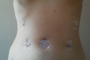 術後の様子。お腹に手術痕がいくつも