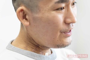 のど元には、手術時の痕がまだ残る。「痛みはまったくありません。今後5年間は、転移や再発がないかを注意深く見ていくことになりそうです」（撮影/齋藤周造）