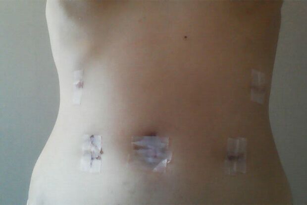 術後の様子。お腹に手術痕がいくつも